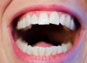 teeth-1652937_1280-(1)
